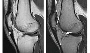 Tendinos vid patella